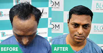 cost of Female hair transplant in mumbai