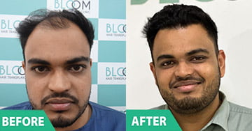 hair implant in pune