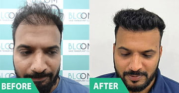 cost of Scalp Micro Pigmentation (SMP) in pune