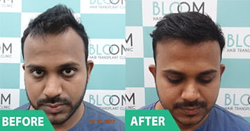 best BEARD & MUSTACHE HAIR TRANSPLANT mumbai