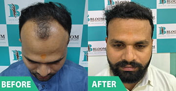 best SAPPHIRE HAIR TRANSPLANT mumbai