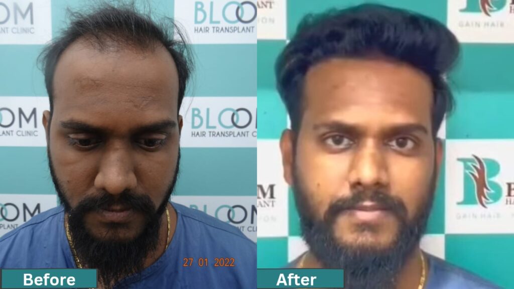 mumbai hair transplant cost