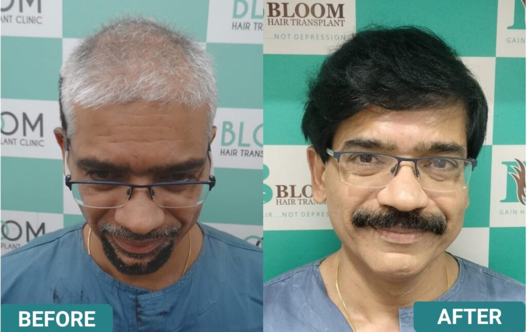 Cheapest hair transplant in mumbai