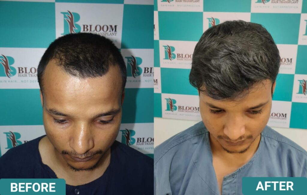 best ROBOTIC HAIR TRANSPLANT in mumbai