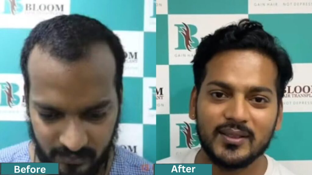 Direct hair Transplant in Mumbai