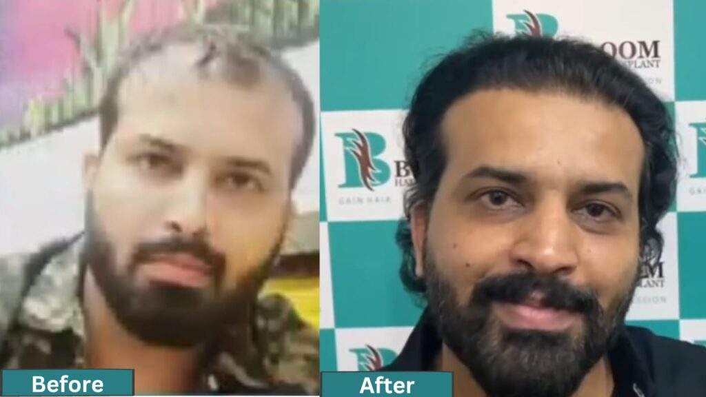 Hair Transplant cost in Maharashtra