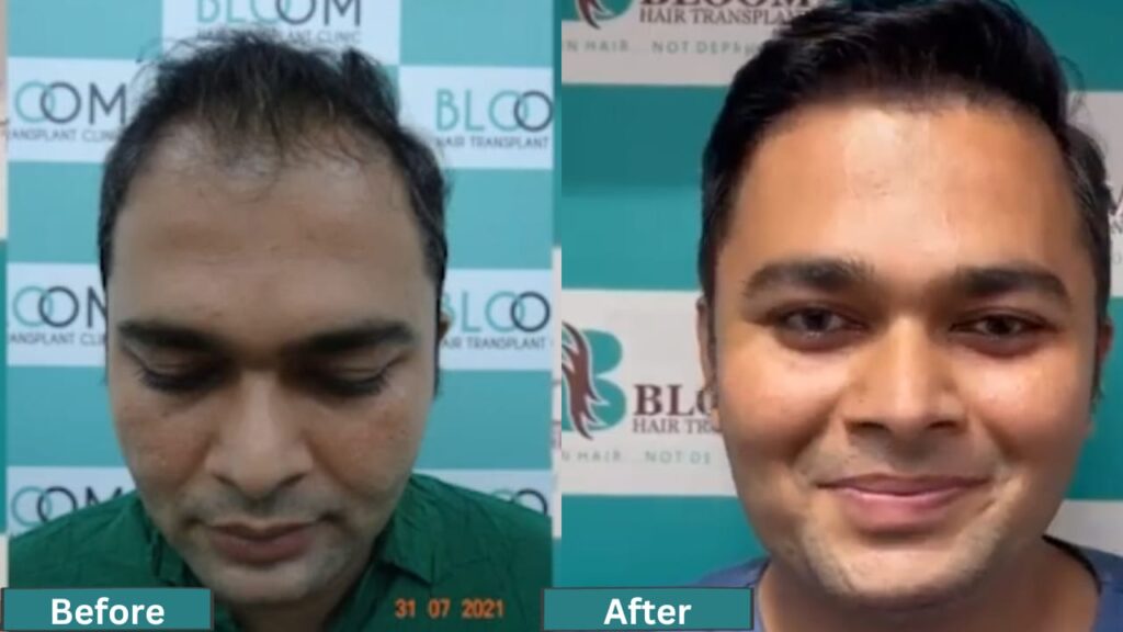 FUE hair transplant