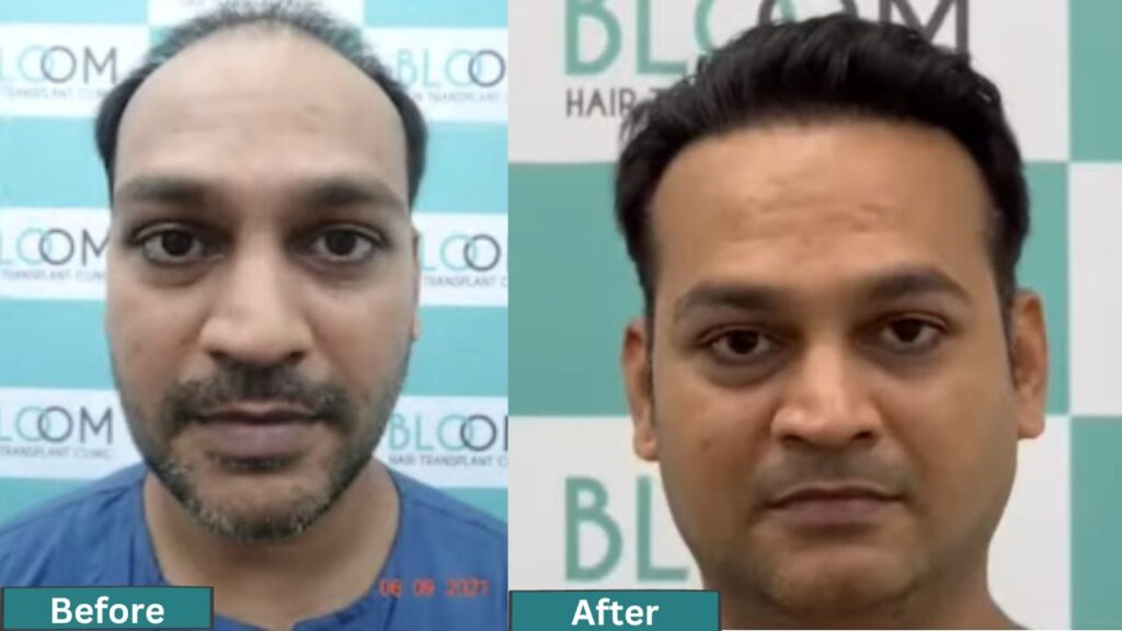 hair transplant charges in india