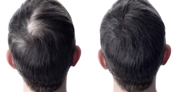 Decoding Hair Loss: Understanding the Genetic Blueprint Behind Thinning Locks