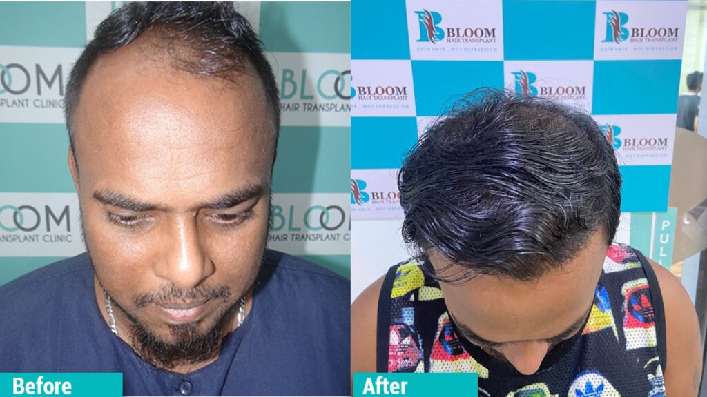 Best DHI Hair Transplant clinic in Maharashtra