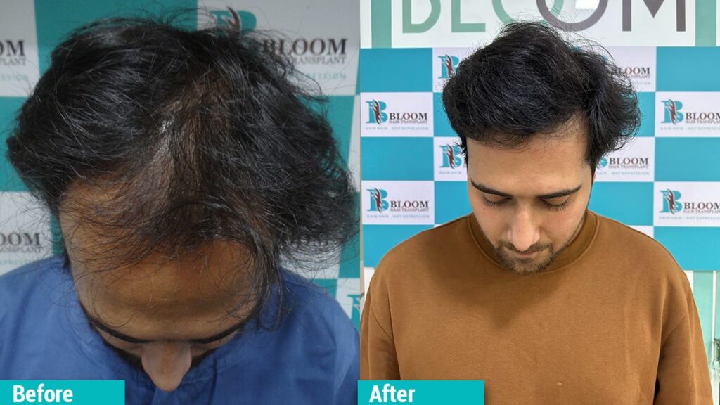 Direct hair Transplant in Mumbai