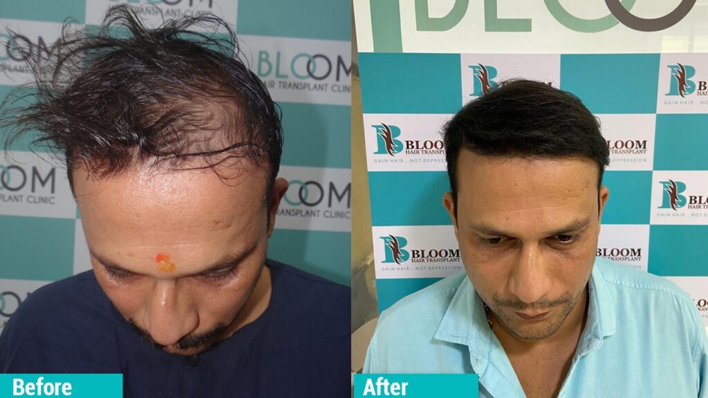 Top Hair Transplant In Mumbai