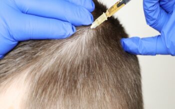 Decoding Hair Loss Patterns: Choosing the Right Transplant Method