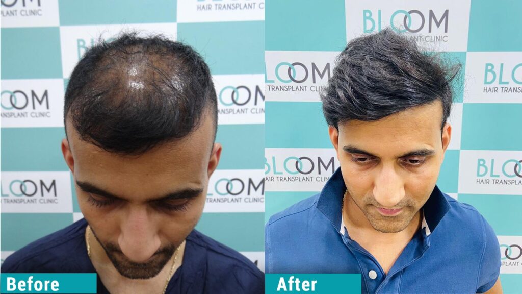 Hair transplant in mumbai