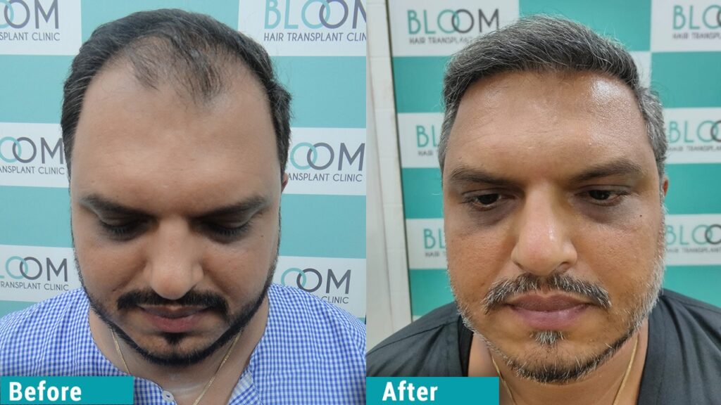 Hair restoration in mumbai