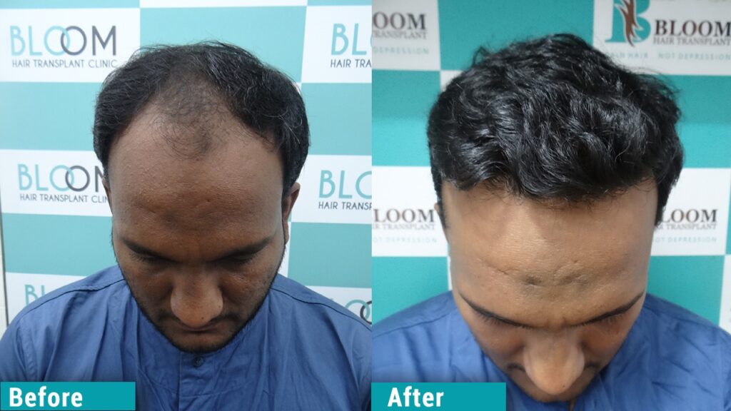 Best hair transplant in mumbai