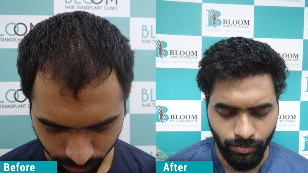 Hair transplant