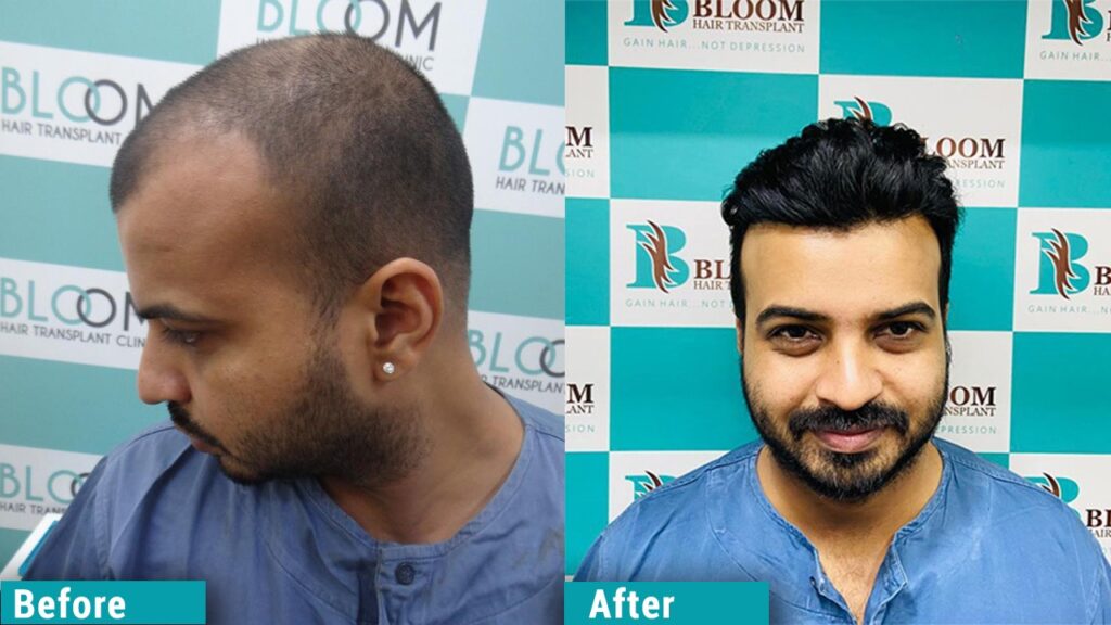 Hair transplant clinic in mumbai