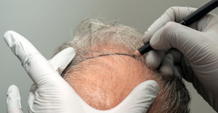 Hair Transplant Myths and Facts