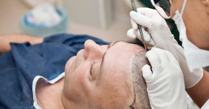 FUE Hair Transplant: The Solution to Premature Hair Loss