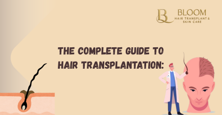 The Complete Guide to Hair Transplantation: Is It the Right Solution for You?