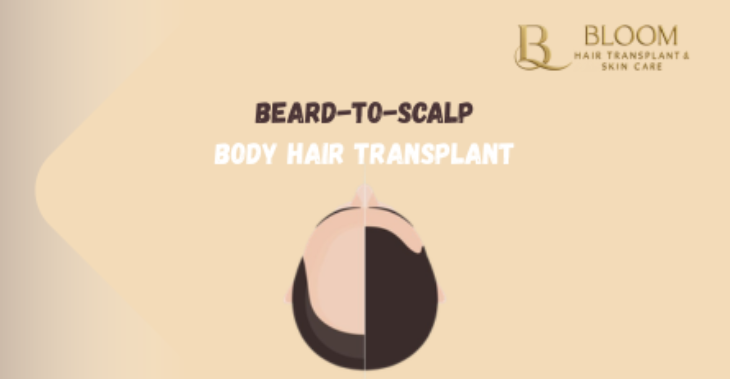 Beard-to-Scalp and Body Hair Transplant (BHT): Solutions for Advanced Baldness