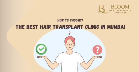 How to Choose the Best Hair Transplant Clinic in Mumbai: A 10-Point Checklist