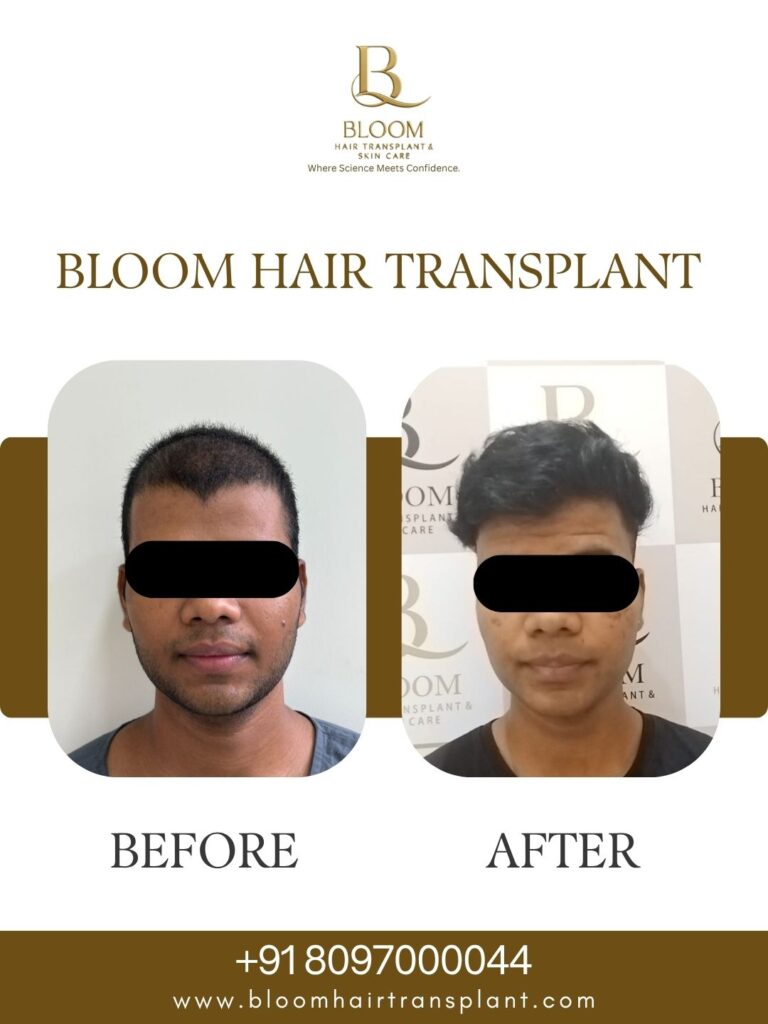 bloom-hair-transplant