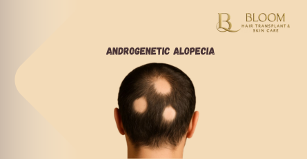 Androgenetic Alopecia: Causes, Symptoms & Daily Coping Guide