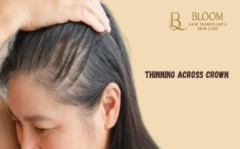 Diffuse Thinning Across Crown: Warning Signs for Women