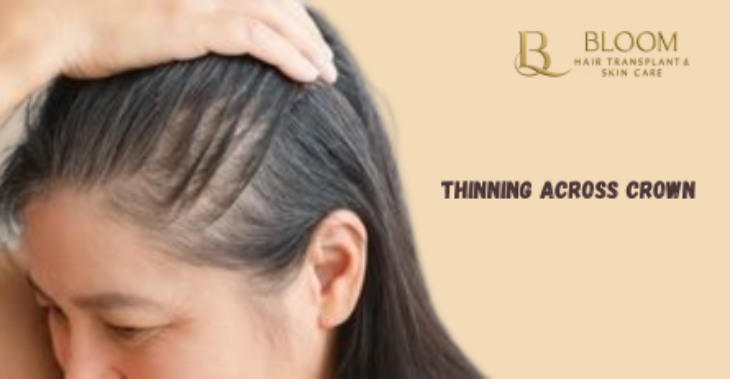Diffuse Thinning Across Crown: Warning Signs for Women