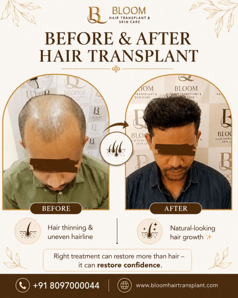 hair-transplant-result