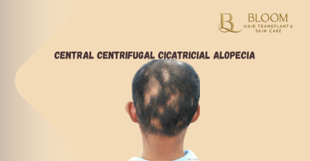 Central Centrifugal Cicatricial Alopecia Explained Simply