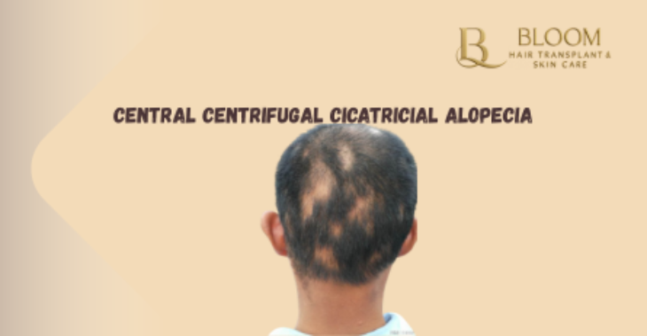 Central Centrifugal Cicatricial Alopecia Explained Simply