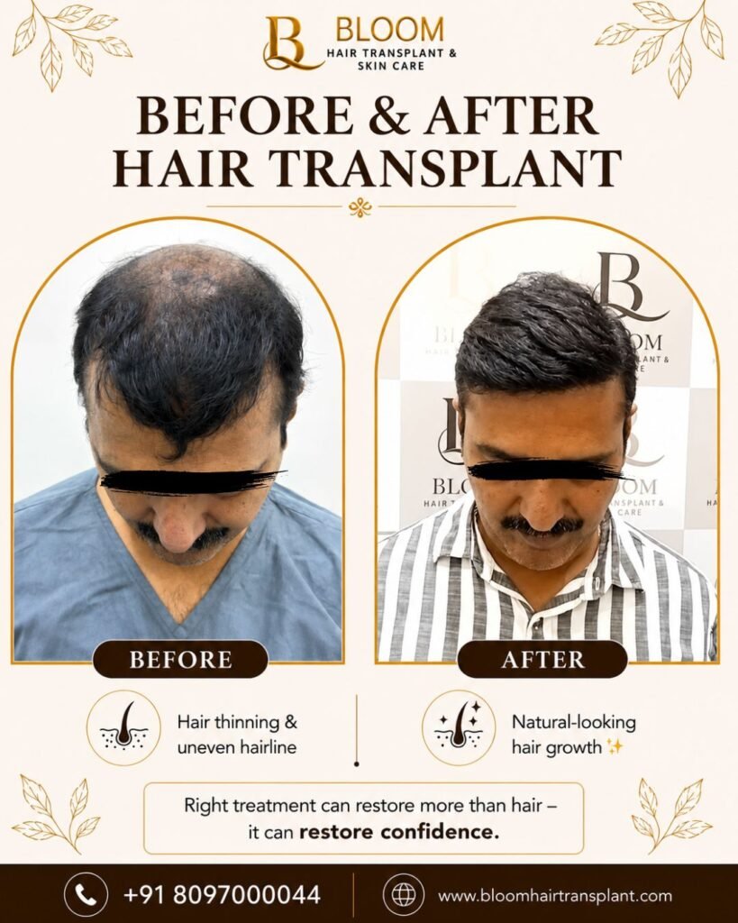 Hair-Transplant-Result