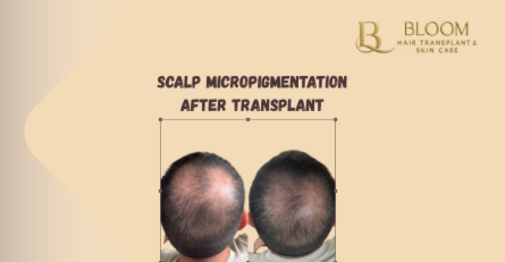 Scalp Micropigmentation After Transplant: Understanding Combo Results