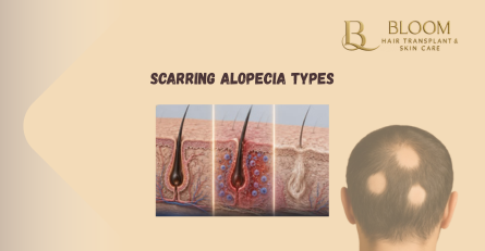 Scarring Alopecia Types: What Causes Permanent Baldness?
