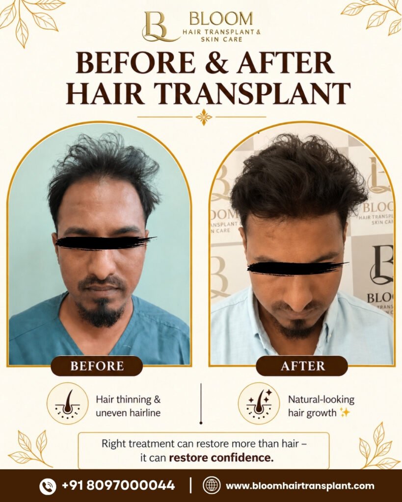 Hair-transplant-Before-After