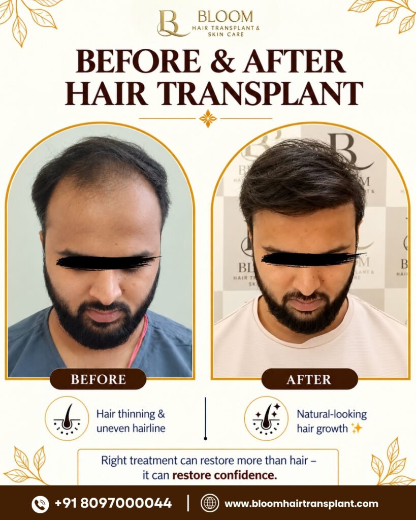 Hair-transplant-Before-After