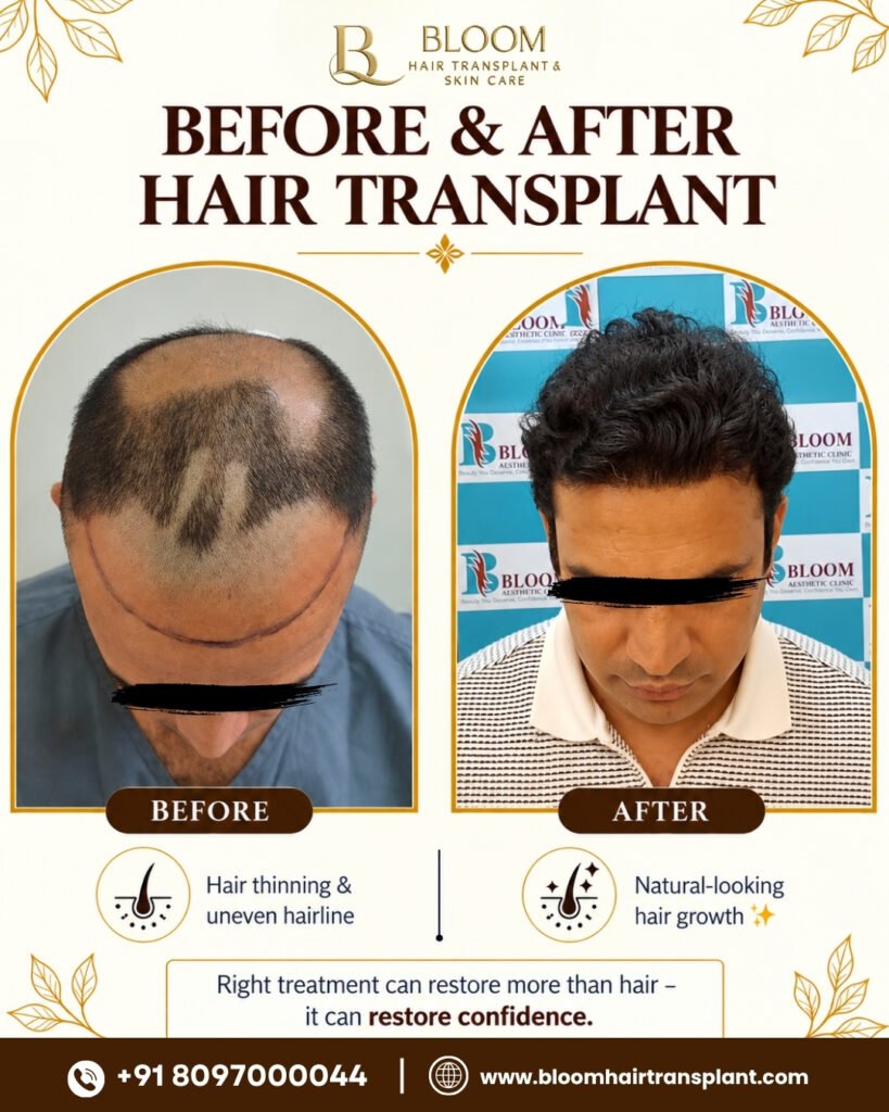 Hair-transplant-Before-After