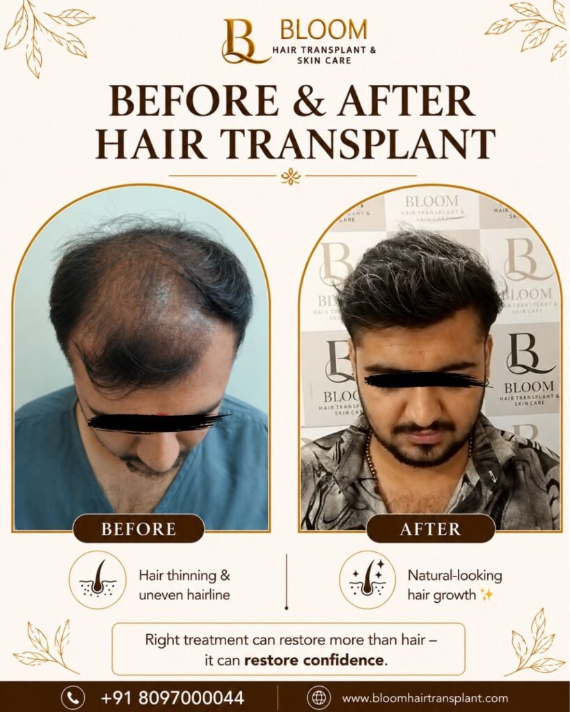 Hair-transplant-Before-After