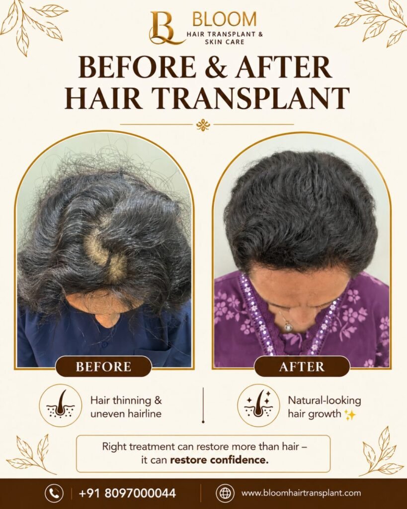 Hair-transplant-Before-After