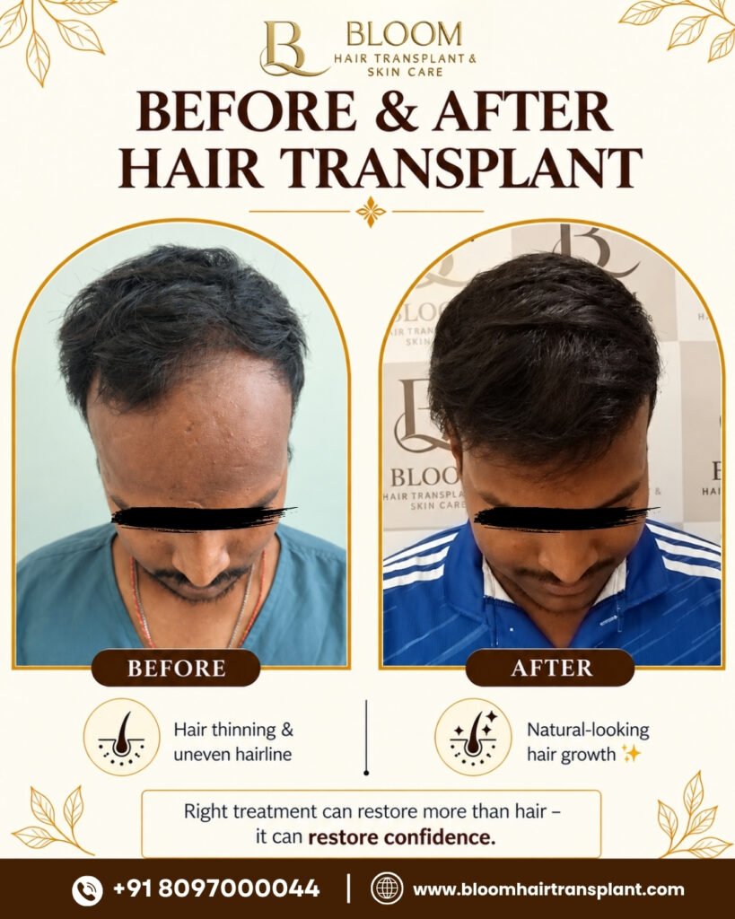 Hair-transplant-Before-After