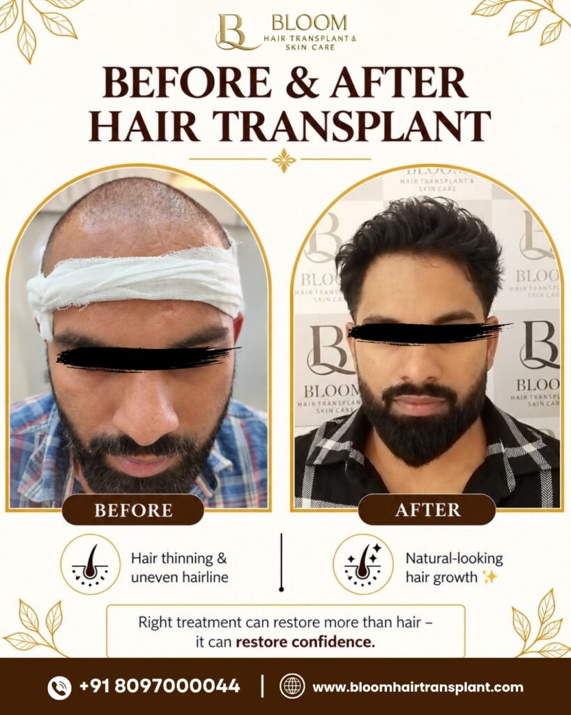 Hair-transplant-Before-After