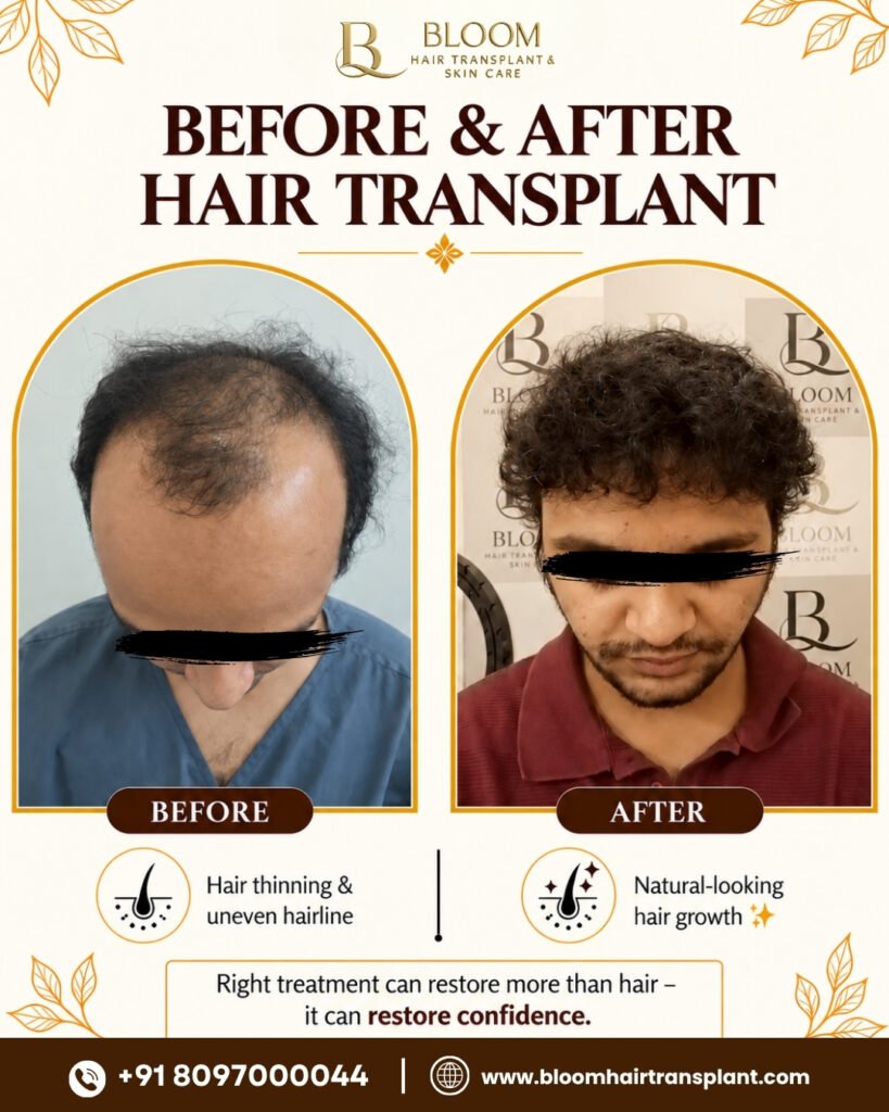 Hair-transplant-Before-After