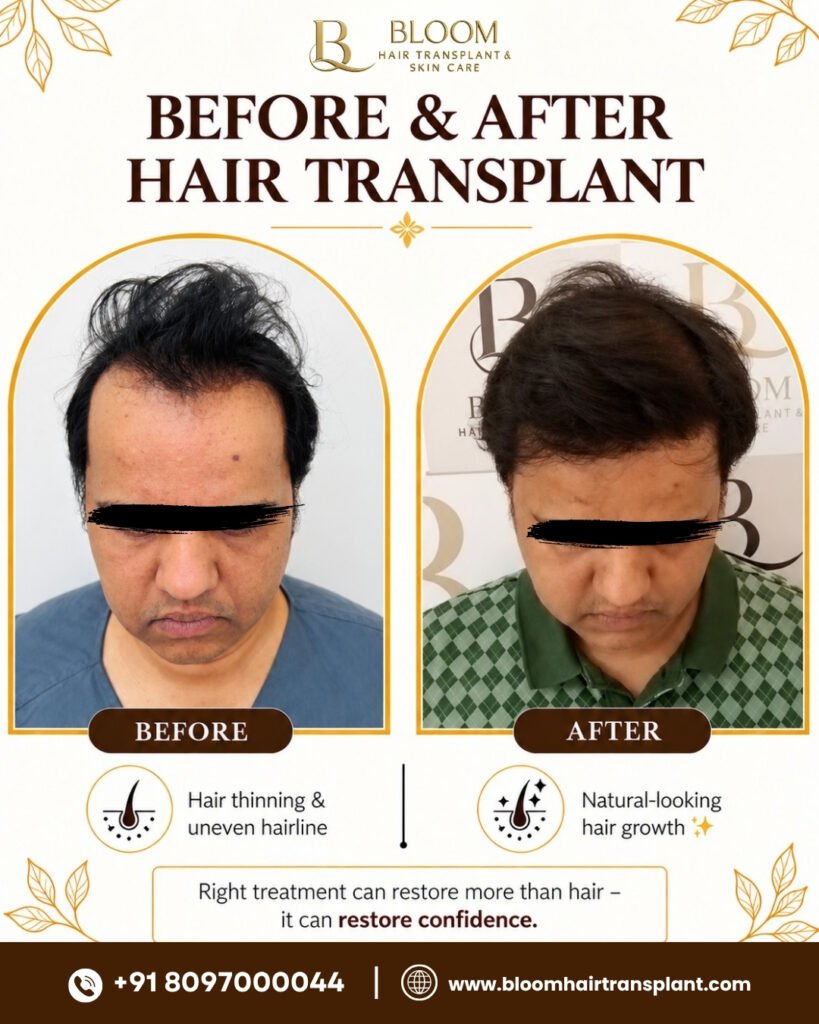 Hair-transplant-Before-After