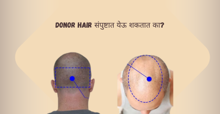 Donor Hair संपुष्टात येऊ शकतात का? Can Donor Hair Get Exhausted?