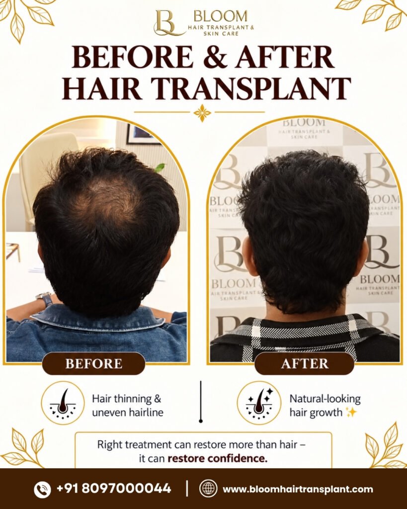 Hair-transplant-Before-After